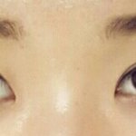 [<b>쌍수</b>] <b>쌍수</b>한지 3달지났어요~0~