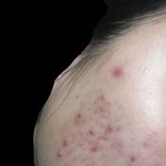 [조언부탁] 여드름이 너무심해요 도와주세요(사진약혐