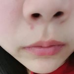 여드름짠후에 뭐발라??