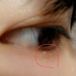 [댓글부탁해] <b>눈밑</b>에 하얀먼가낫는데 이거뭔지아는분 ㅠㅠㅠㅠㅠㅠ