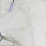 [EXO] 껌씹다가 <b>어금니</b> 조각 나옴