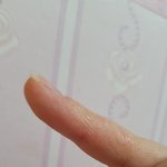 <b>내손</b>이거습진이야?ㅠㅠ