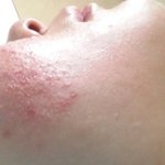 [댓글부탁해] 약혐)여드름 치료 받았는데 <b>압출</b>하고 레이저!