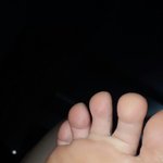 이거 <b>무좀</b>이야??