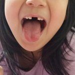 첫니뽑고 <b>신난</b> 우리딸~ㅋㅋ