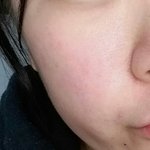 선크림 잘못써서 피부 완전 뒤집어졌는데 어떡해ㅜㅜㅠㅠ