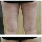 허벅지 붉은튼살 다 없애구 왔어용ㅋㅋ