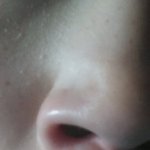 [하후하후하] 살다보니 <b>코안</b>에 여드름 났는데 어떻게하죠...