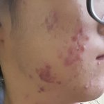 [댓글부탁해] 혐주의)얘들아 <b>여드름</b>어떻게없애?