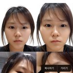 얼평 및 성형 <b>견적</b> 부탁드립니다