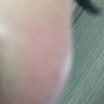 [꼭봐주세요] <b>하이코</b> 성형외과 부작용인것 같은데 아니라고해요.....