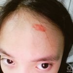 [드루와] 나 <b>이마</b>에서 피났어ㅠㅠㅠ(사진ㅇ)