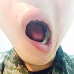 동생이 군 입대하여 안면신경 <b>손상</b>으로 돌아왔습니다.