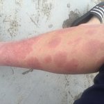 [댓글부탁해] <b>건선</b>이란 피부병.. 도와주세요..