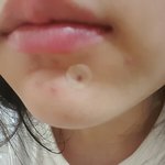 이거 여드름 <b>흉터</b> 아니지...?!?!