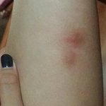 [EXO] 모기가 이렇게 물릴수도있냐