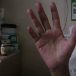 [쿨한백혈병] 쿨한 백혈병 환자의 방문기