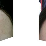 [드루와] 여드름 후기야!