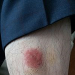 사진보시고 꼭좀 도와주세요. <b>다리피부</b> 사진이고 도저히 낫지 않아서...