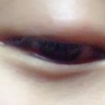 눈하고 <b>코에</b> 모기물림