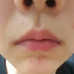 이거 여드름 <b>흉터</b>야???
