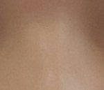 [댓글부탁해] (혐주의) <b>쌍액</b> 3년차  안검하수(눈매교정)+절개...