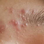 [드루와] <b>좁쌀</b>여드름 없앨수있는팁