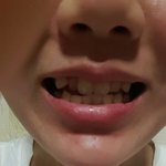 <b>치아</b>가 콤플렉스인 애들있누ㅣ!!