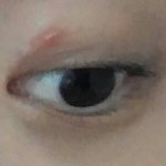 [조언부탁] 쌍꺼풀 수술 부작용..<b>염증</b>인가요