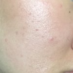 [댓글부탁해] ㅁㅊ나 피부어떡함 ㅠㅠ (극극혐)
