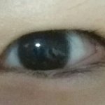 쌍꺼풀 <b>생김</b>