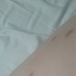 [댓글부탁해] 모기<b>흉터</b>?