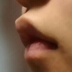 [꼭댓글부탁] <b>돌출</b>입aso수술