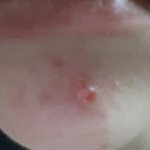 [조언부탁해] 여드름짯는데ㅠㅠㅠㅠㅠ(혐주의)