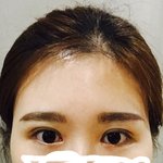 [댓글부탁해] <b>비절개</b>눈매교정+앞트임 12일째인데 봐쥬세용