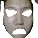 [조언부탁해] 대박 나 갑자기 여드름 ㅈㄴ 올라옴;;;;(<b>사진주의</b>)