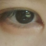[댓글부탁해] 앞트임후 이거뭐야ㅠㅠㅠ?