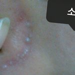 [<b>극혐</b>] 내 피부 왜이래...ㅠ