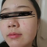 내인생 최악의 <b>피부</b>