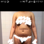 복부 허벅지 목살 지방흡입후기