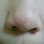 [댓글부탁해] <b>코에</b> 껍질같은거 생겼는데