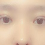 쌍수 <b>부분</b>절개 하구왓는데 어떤가요??