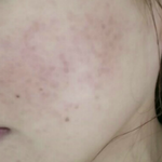 여드름흉터 + 좁쌀여드름 극복후기 루틴