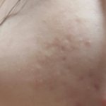 (약혐주의)나 피부좀봐줘ㅠㅠ