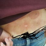 [조언부탁] 한의원에서 <b>치료</b>받았어요 (사진인증)