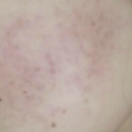 [화장품전후] 보나쥬르 DERMA MDK <b>앰플</b> 사용전/후