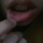 [ㅋㅋㅋㅋㅋ] (약혐)얘드라 ㅜㅜ나 <b>입병</b>낫는데 엄청 크다 ..
