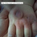 매일 <b>피범벅</b>이었던 아토피 다 나았네요