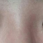 쌍수 5일차인데 어떤가요?