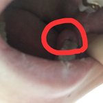 [댓글부탁해] 잇몸 <b>염증</b> 부종 아시는 분이요ㅠㅜ